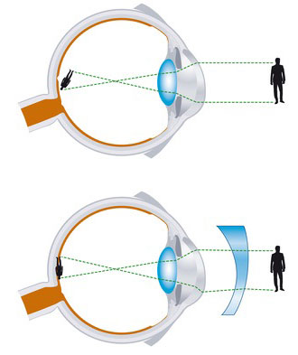 Astigmatismo