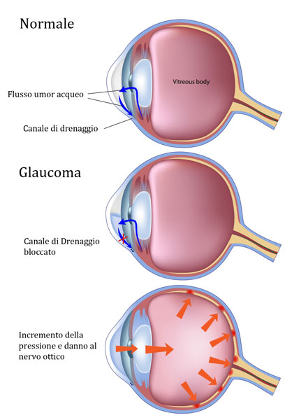 Glaucoma